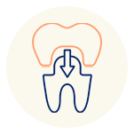 Teeth Restoration We provide teeth restoration at our dental clinic in Vancouver, including fillings and crowns