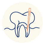 Root canal therapy Our root canal services at the best dental clinic in Vancouver offer pain relief and restoration