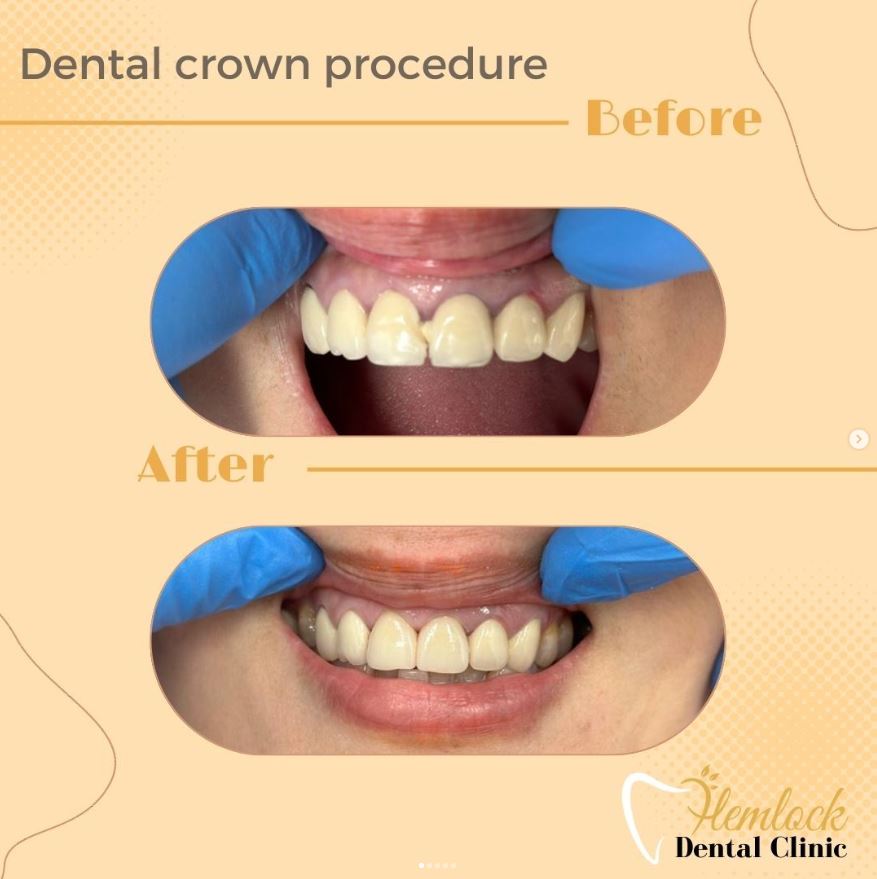 dental clinic in vancouver -Crown
