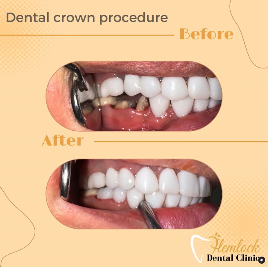 dental clinic in vancouver -Crown