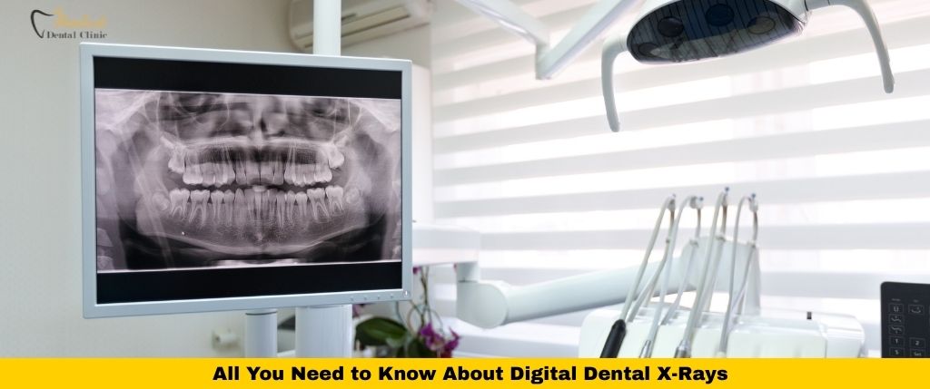 All You Need to Know About Digital Dental X-Rays