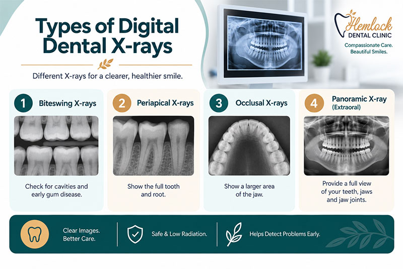 Types of digital dental X-rays infographic showing bitewing, periapical, occlusal, and panoramic X-rays and their main uses