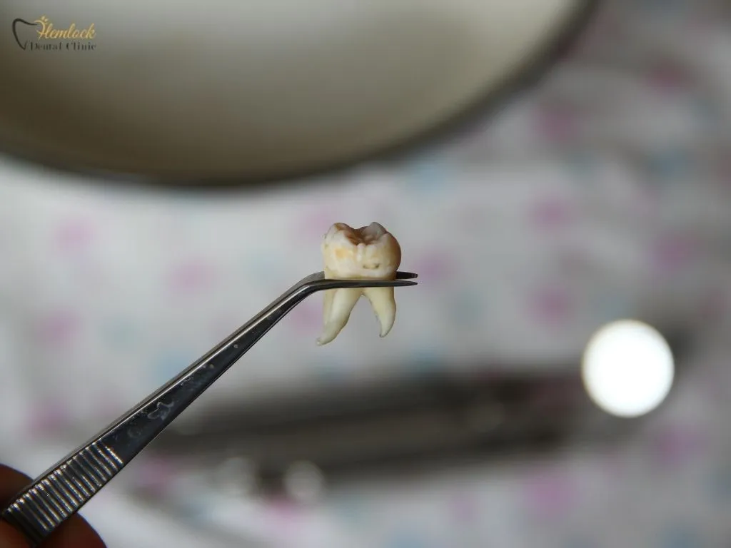 Learn about root canal recovery time, healing timeline, and a real wisdom tooth extraction story from Vancouver’s trusted dentist, Dr. Alavi.