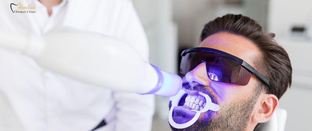 Foods to Avoid After Teeth Whitening