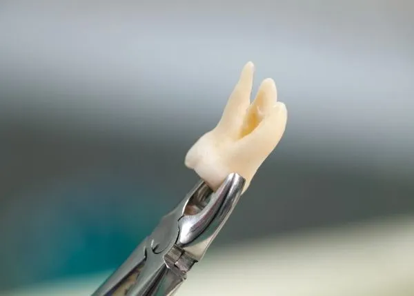 Do You Need a Crown-After a Root-Canal- Cracked Tooth Root Canal
