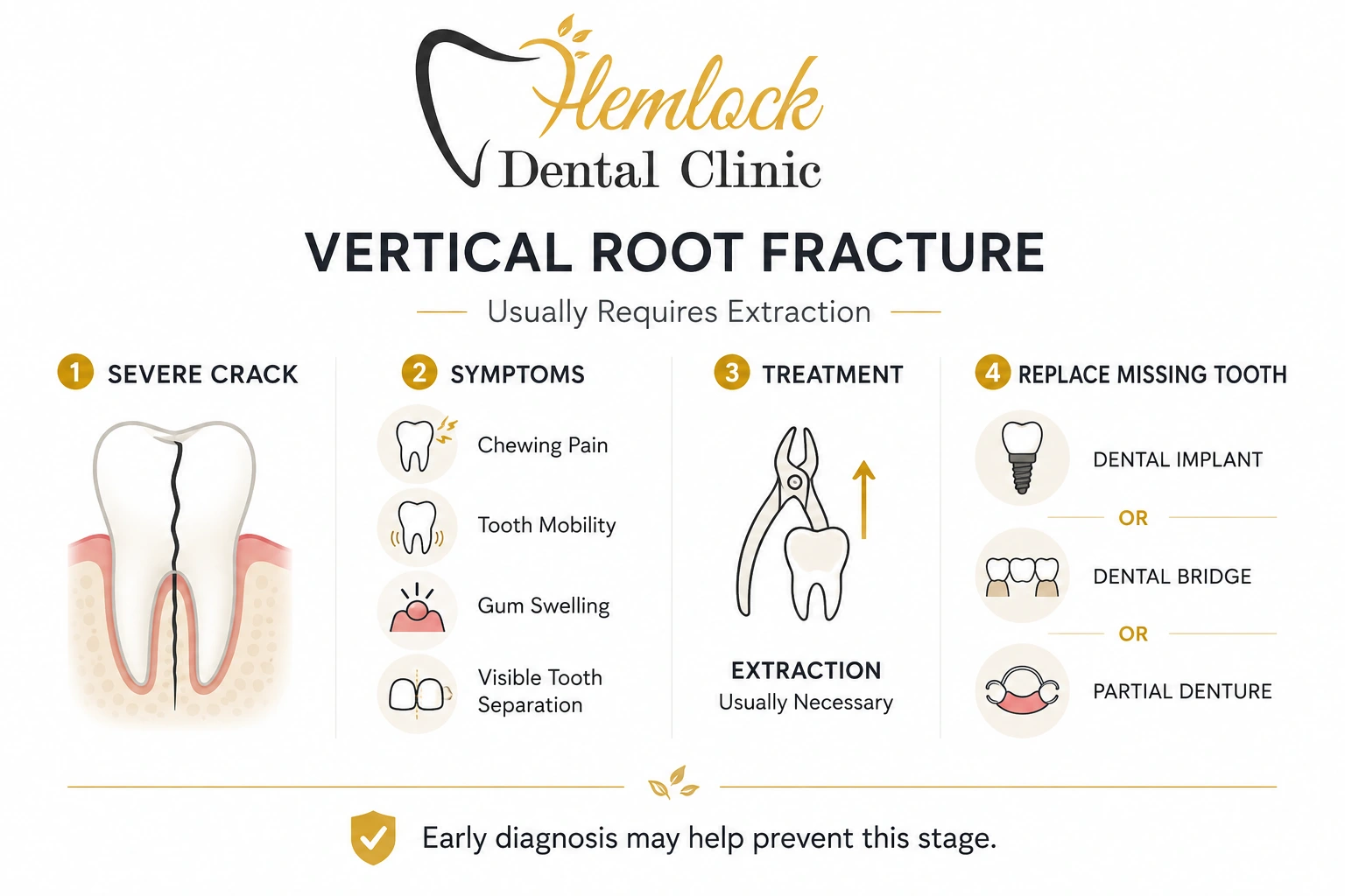 Vertical root fracture infographic showing symptoms, extraction treatment, and tooth replacement options