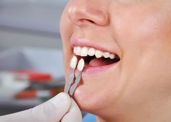 How Much Are Veneers in BC? Complete 2025 Guide to Costs, Types & Insurance Coverage 2 Dentist matching porcelain veneers to patient’s natural teeth color — how much are veneers in BC