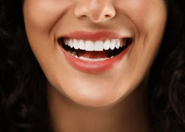 ide view of dental veneers in Vancouver highlighting natural-looking and durable results.