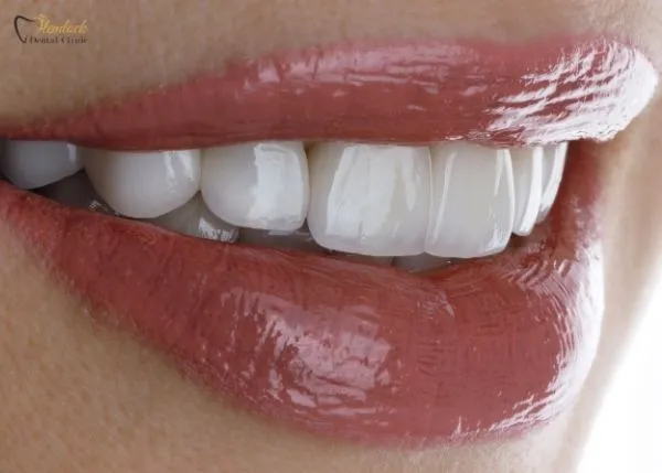 Beautiful smile with dental veneers in Vancouver, showing straight and bright teeth.