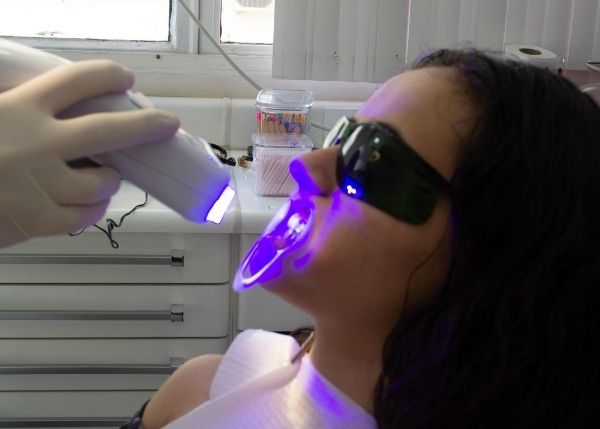 Teeth Whitening Costs in Vancouver 2 Teeth whitening maintenance cost and restoration treatment pricing in Vancouver