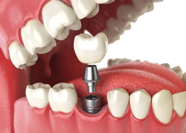 Clinical illustration of titanium implants used in the step-by-step procedure of Dental Implant Surgery in Vancouver, highlighting precise placement and affordable implant techniques.