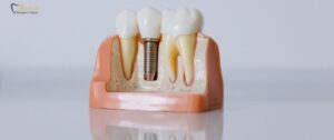Affordable Dental Implant Surgery in Vancouver