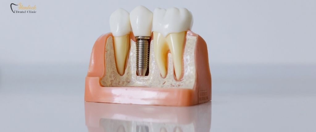 Affordable Dental Implant Surgery in Vancouver
