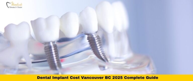 Dental Implant Cost Vancouver BC 2025 Complete Guide