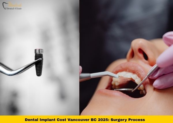 Dental Implant Cost Vancouver BC 2025 Complete Guide 3 Dental Implant Cost Vancouver BC 2025_ Surgery Process