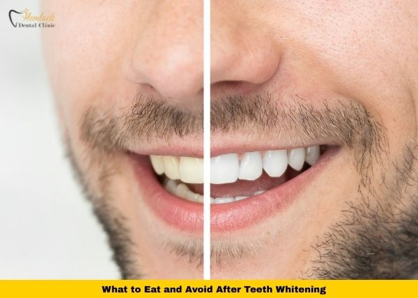 What to Eat After Teeth Whitening (White Diet Guide for Vancouver) 1 Split before-and-after close-up of a man’s smile showing brighter teeth after whitening, used for content about what to eat and avoid after teeth whitening.