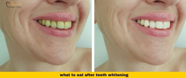 What to Eat After Teeth Whitening (White Diet Guide for Vancouver)​