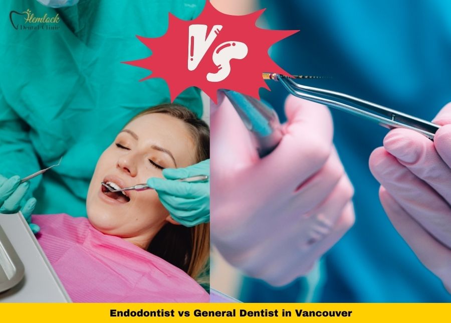 What Is an Endodontist? Endodontist vs Dentist in Vancouver 1 Endodontist vs General Dentist in Vancouver