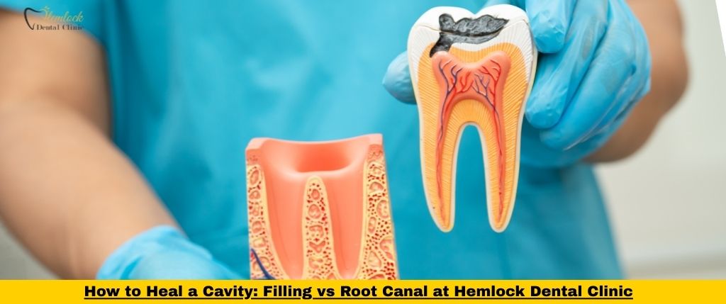 Dental Clinic Blog 1 How can you heal a cavity? Read this article to find out all the details about cavities vs root canal.