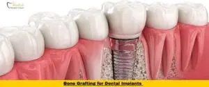 Bone Grafting for Dental Implants