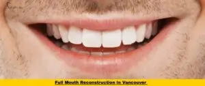 Close-up smile result after full mouth reconstruction in Vancouver, showing natural-looking white teeth and restored bite at Hemlock Dental Clinic.