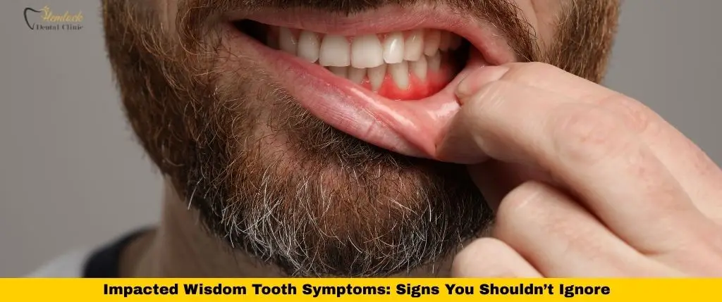 Dental Clinic Blog 1 impacted wisdom tooth symptoms showing swollen red gum around lower wisdom tooth