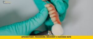 Apicoectomy: Procedure, Recovery & Success Rate