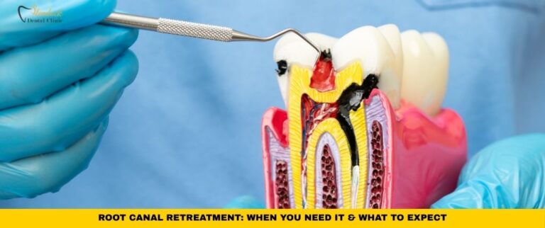 Root canal retreatment illustration showing a tooth with treated root canals