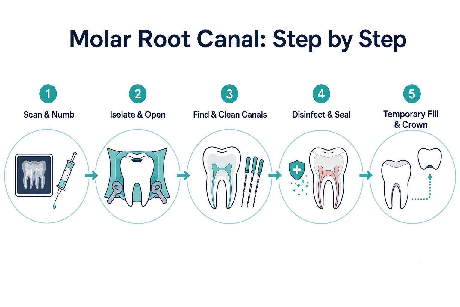 Infographic explaining the main steps of root canal of molar teeth, including scan and anesthesia, tooth isolation, canal cleaning, disinfection, sealing, and crown placement.