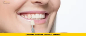 Dental veneers used to improve the appearance of stained, chipped, and uneven teeth