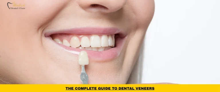Dental veneers used to improve the appearance of stained, chipped, and uneven teeth
