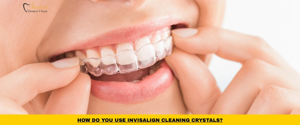 How to use Invisalign cleaning crystals to clean clear aligners and remove buildup
