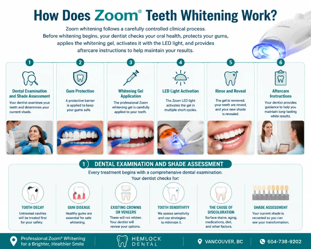 Infographic showing how Zoom teeth bleaching works, including dental examination and shade assessment, gum protection, whitening gel application, LED light activation, rinse and reveal, and aftercare instructions.