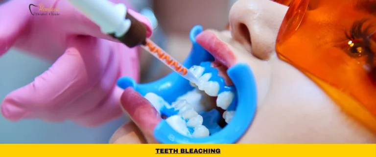 Professional teeth bleaching treatment in Vancouver using dentist-supervised peroxide whitening