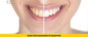 Zoom teeth bleaching treatment in Vancouver using Philips professional whitening system