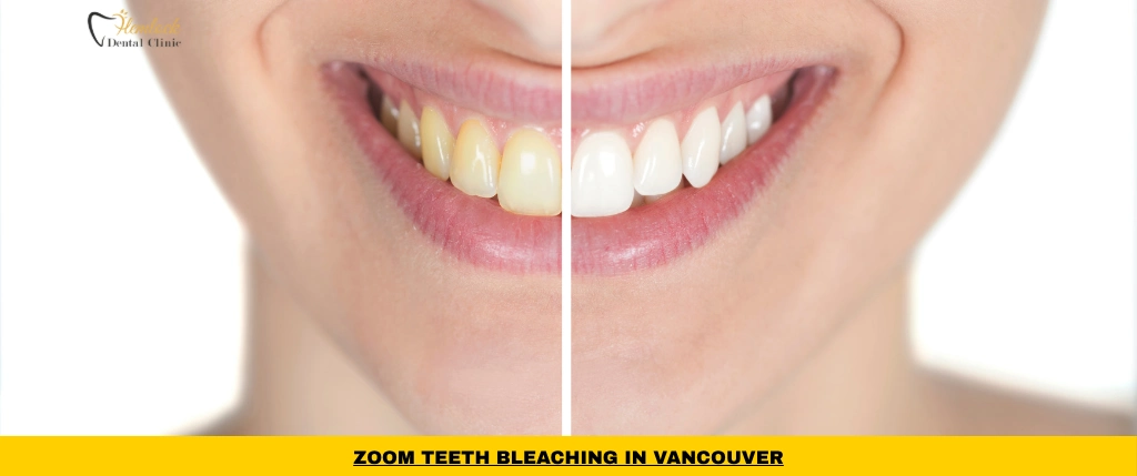 Zoom teeth bleaching treatment in Vancouver using Philips professional whitening system