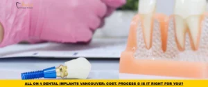 All-on-4 dental implants Vancouver treatment option with implant-supported full arch restoration