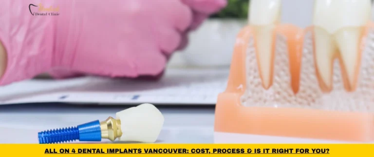 All-on-4 dental implants Vancouver treatment option with implant-supported full arch restoration
