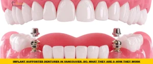 Implant supported dentures attached to dental implants for improved stability and comfort