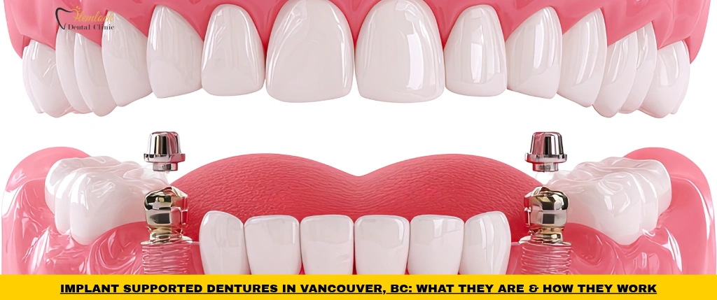 Implant supported dentures attached to dental implants for improved stability and comfort