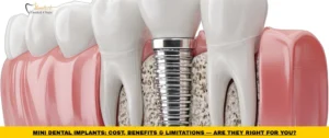 Mini Dental Implants supporting a dental restoration and improving denture stability