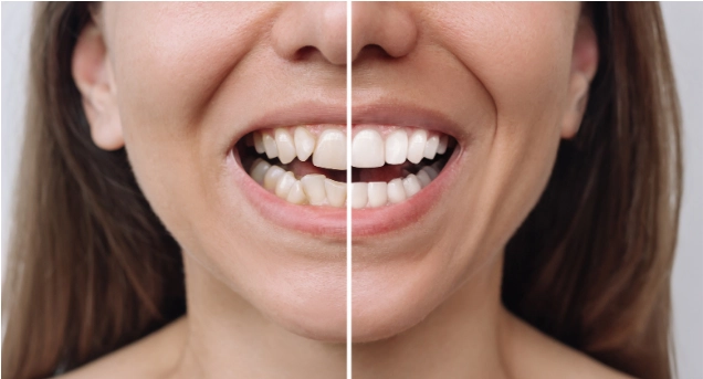 crowded teeth dental before after