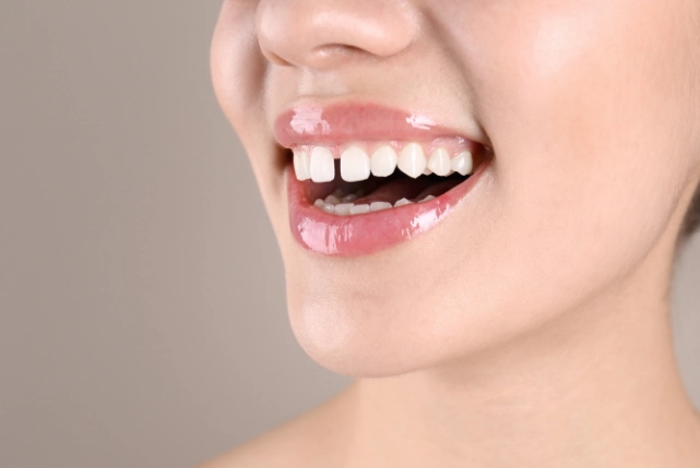 teeth gap