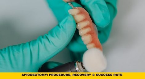 Apicoectomy: Procedure, Recovery & Success Rate