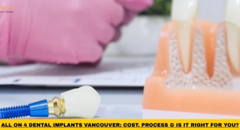 All-on-4 dental implants Vancouver treatment option with implant-supported full arch restoration