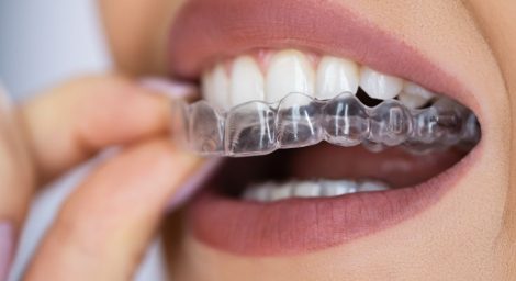 Best Night Guard for Teeth Grinding in 2025_ What You Need to Know