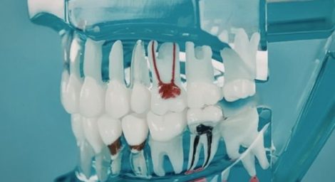 Extract tooth vs root canal comparison showing a dentist explaining treatment options for saving or removing a damaged tooth