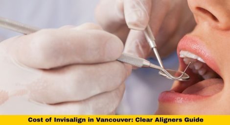 Cost of Invisalign in Vancouver Clear Aligners Guide (1)