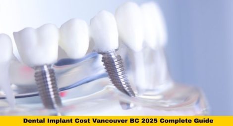 Dental Implant Cost Vancouver BC 2025 Complete Guide