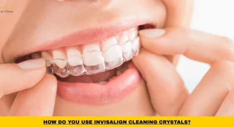 How to use Invisalign cleaning crystals to clean clear aligners and remove buildup